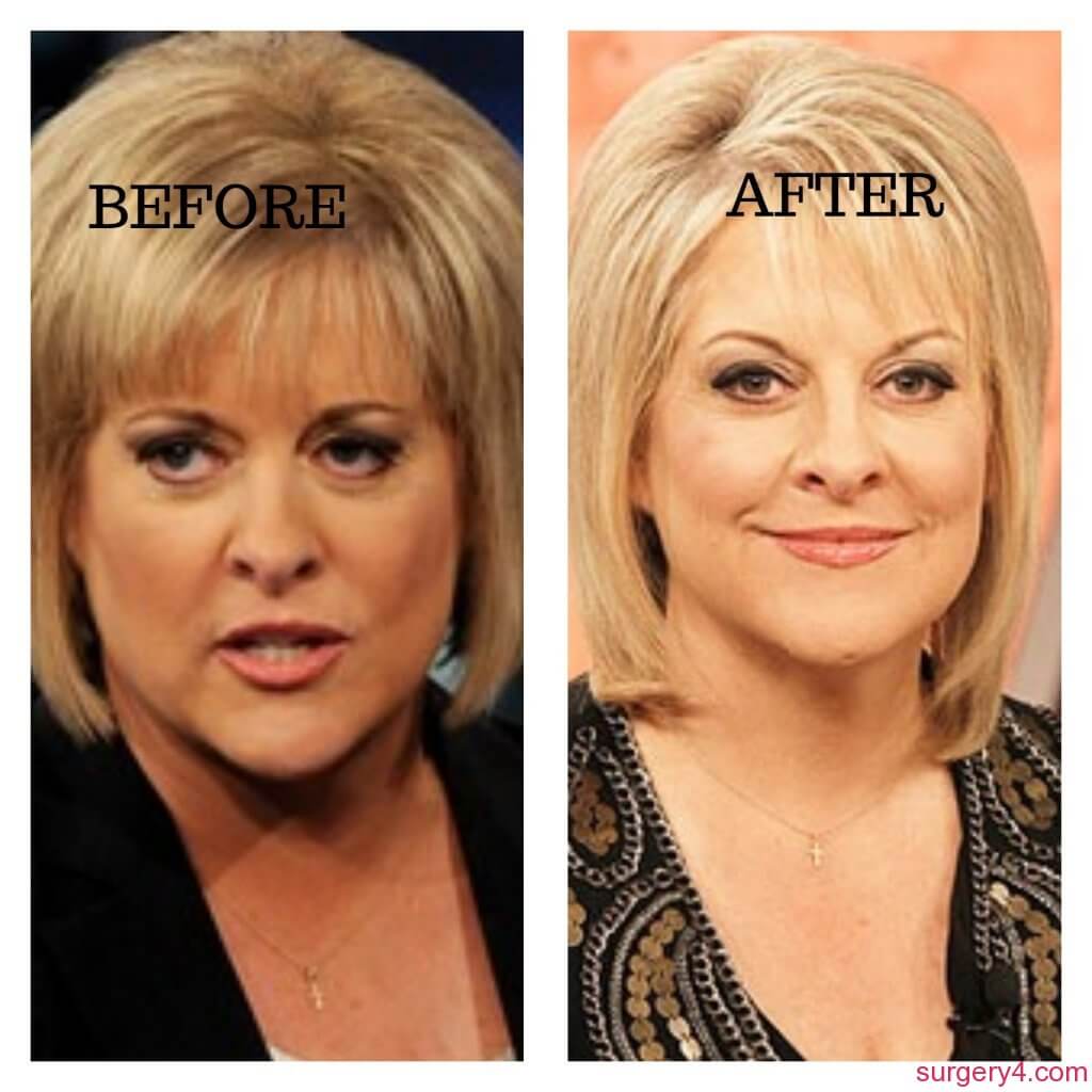 Nancy Grace Plastic Surgery Photos Before After Surgery