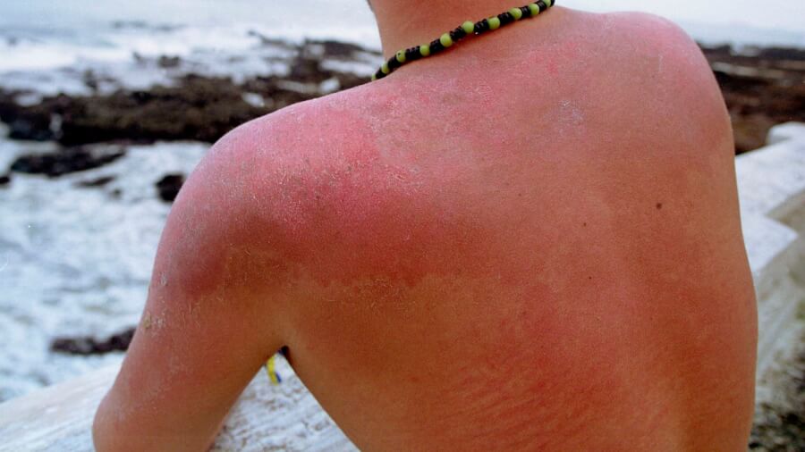 Factors That Affect the Duration of Sunburns