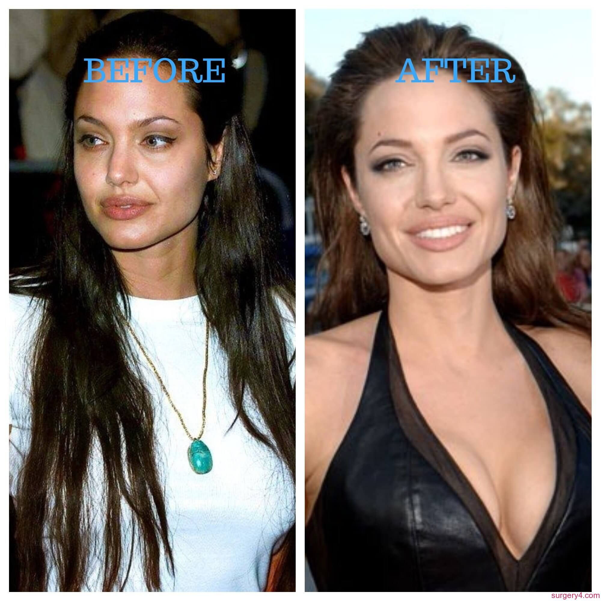 Анджелина Джоли увеличение груди