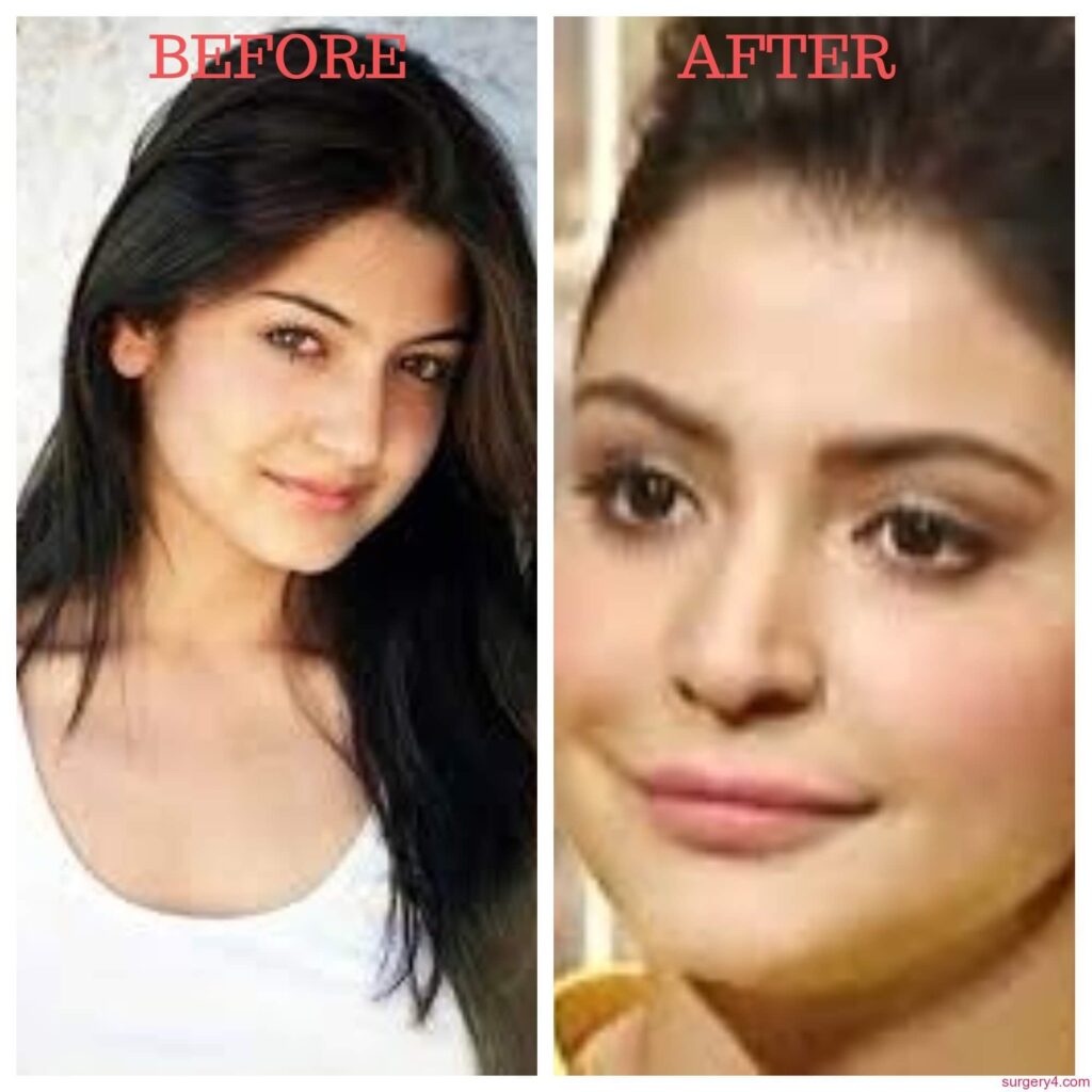 Anushka Sharma Lip Job Photos [Before & After] - Surgery4