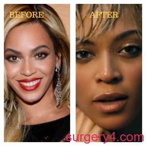 Beyonce Nose Job Photos [Before & After] - Surgery4