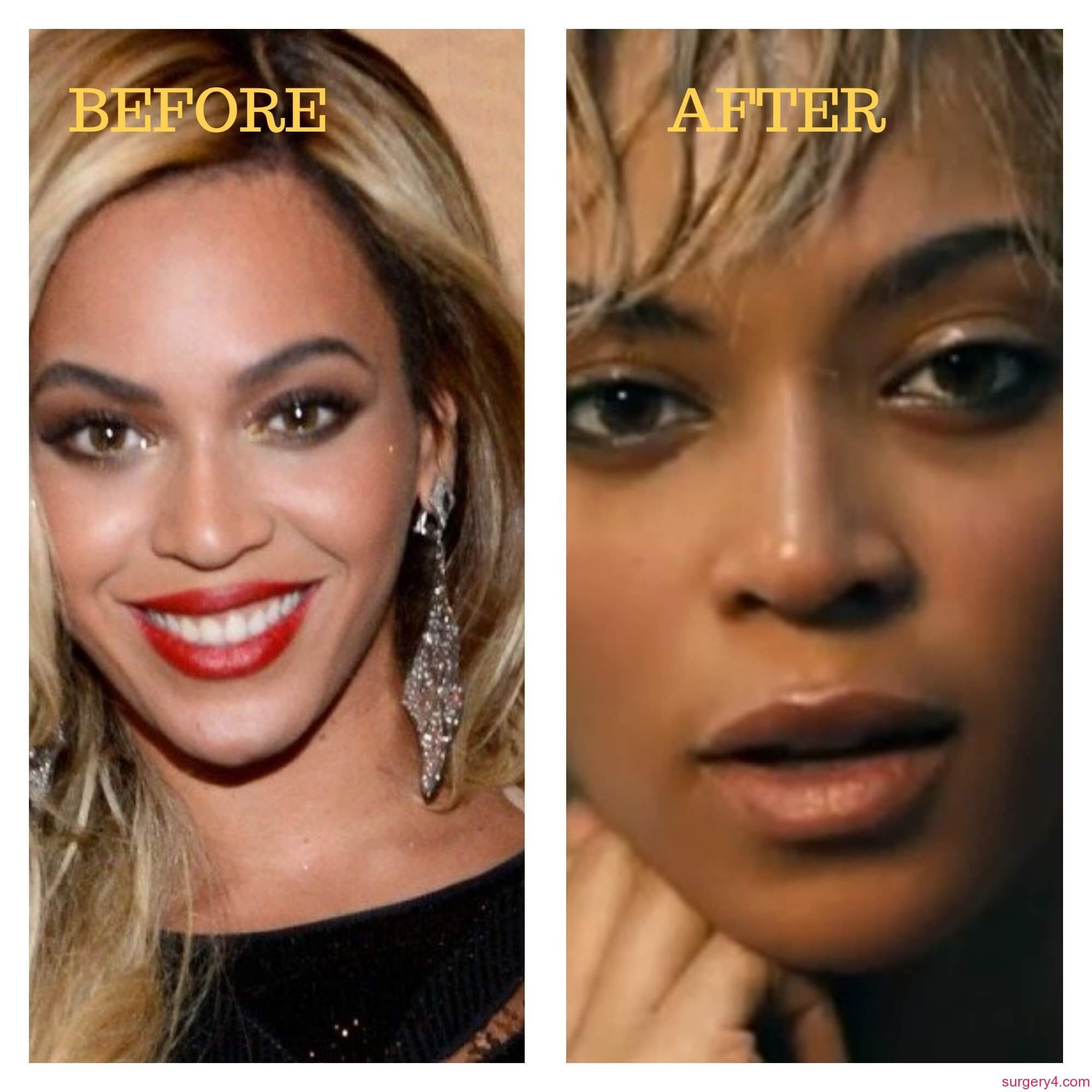 Beyonce Nose Job Photos [Before & After] - Surgery4.