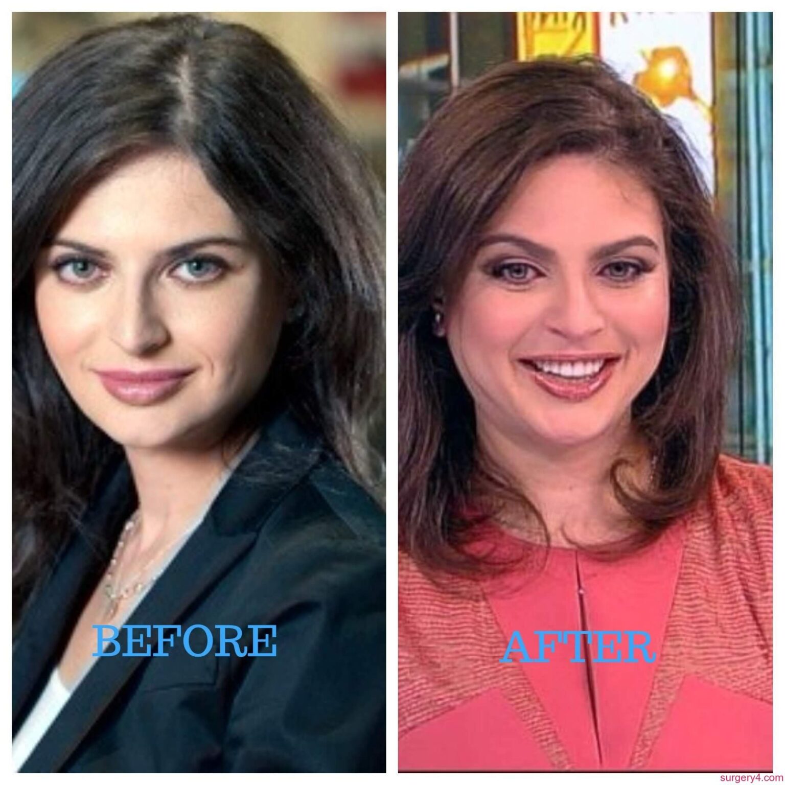 Joan Kennedy Plastic Surgery Photos [Before & After] Surgery4