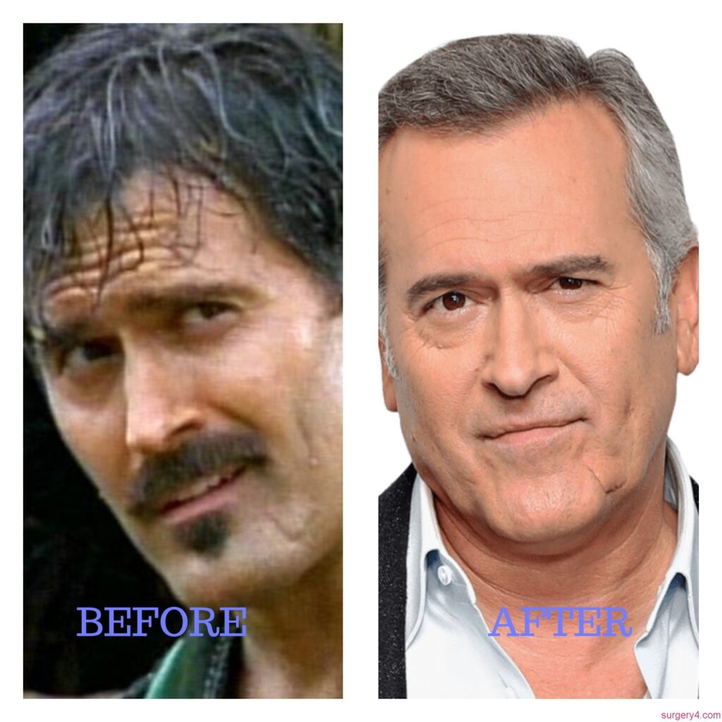 Bruce Campbell Plastic Surgery