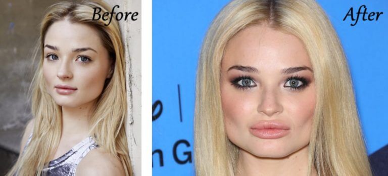 Emma Rigby Plastic Surgery Photos [Before & After] - Surgery4