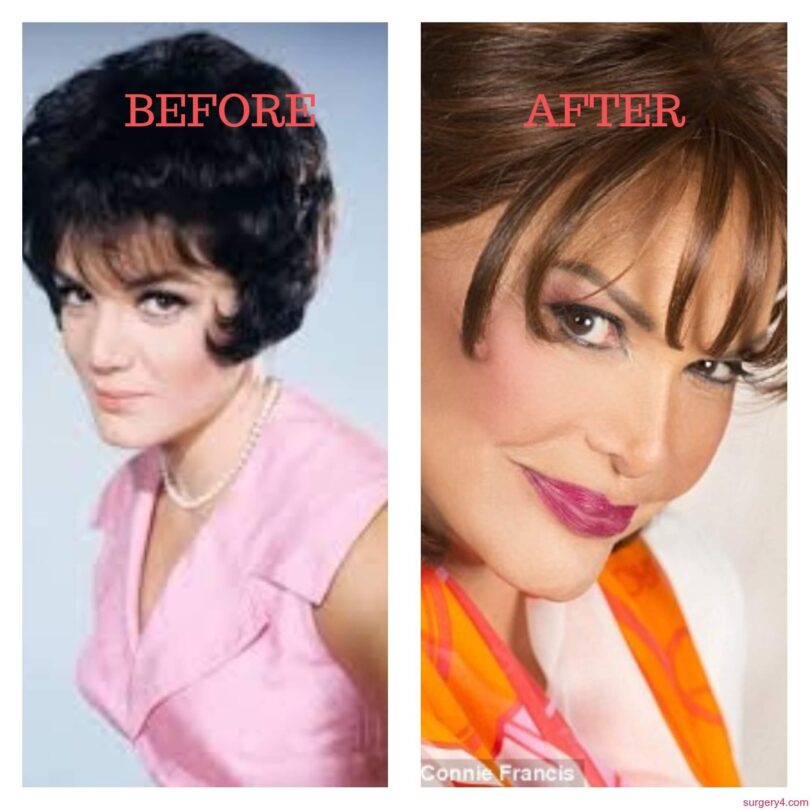 Connie Francis Plastic Surgery - before and after