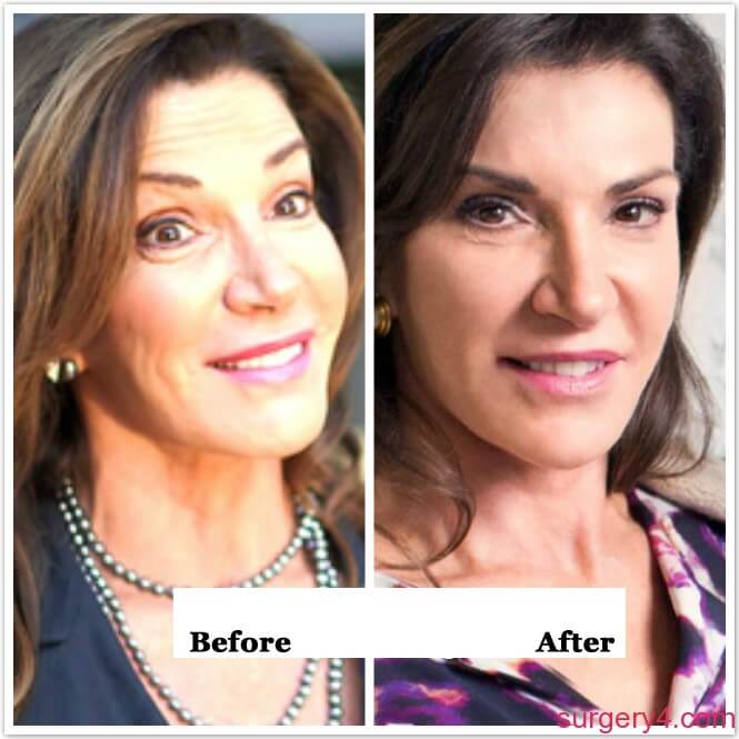 Everything about Hilary Farr Plastic Surgery including her Facelift, Nose j...