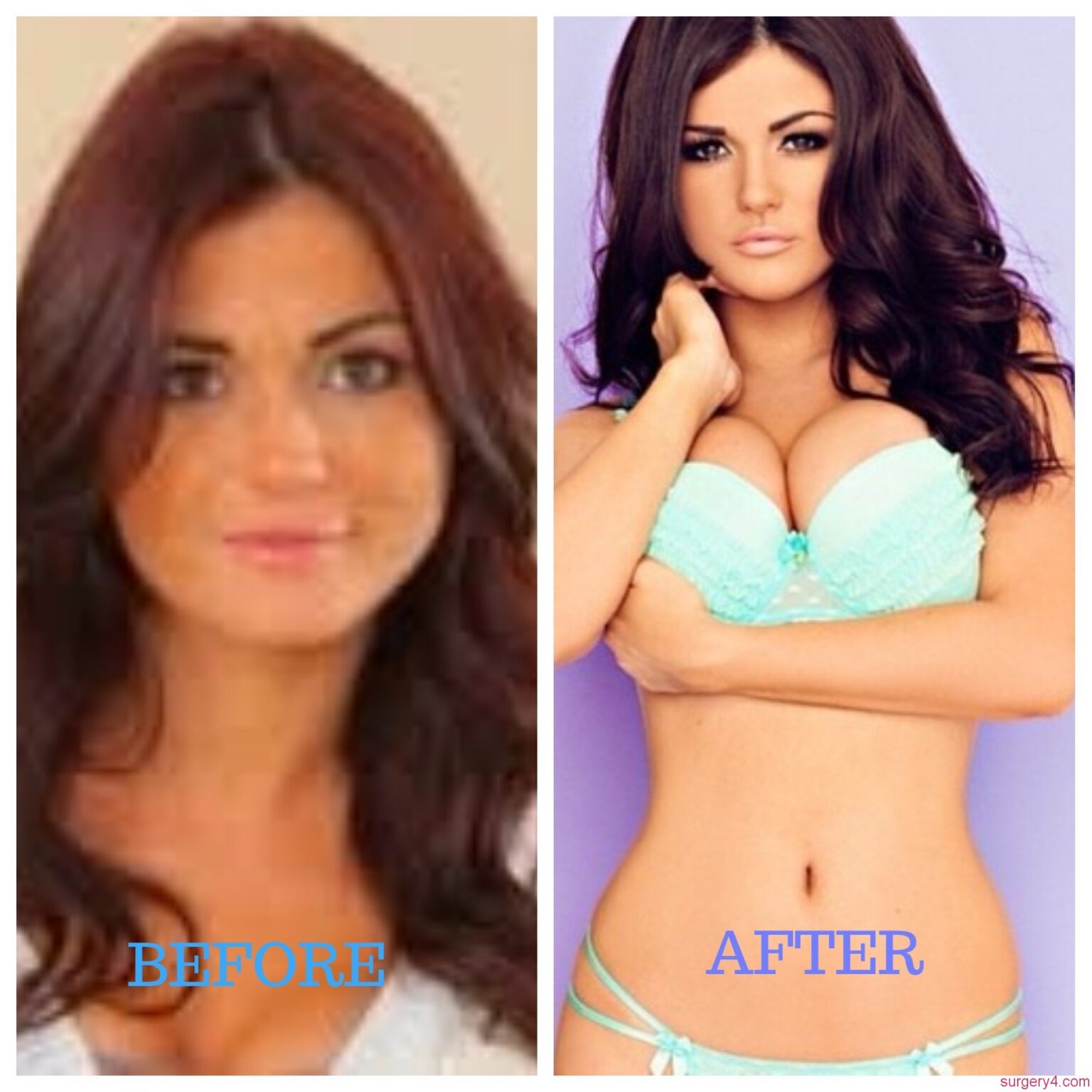 Joan Kennedy Plastic Surgery Photos [Before & After] Surgery4