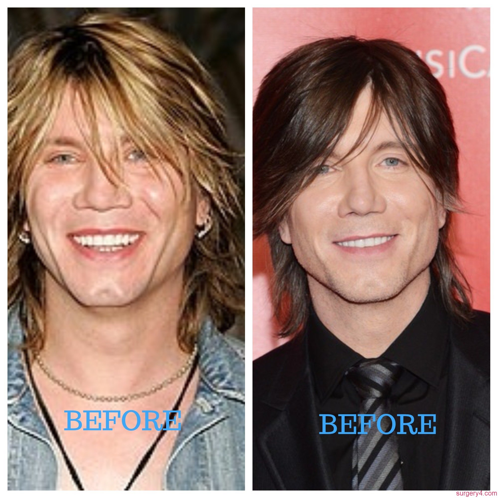 John Rzeznik Plastic Surgery Photos [Before & After] - Surgery4.