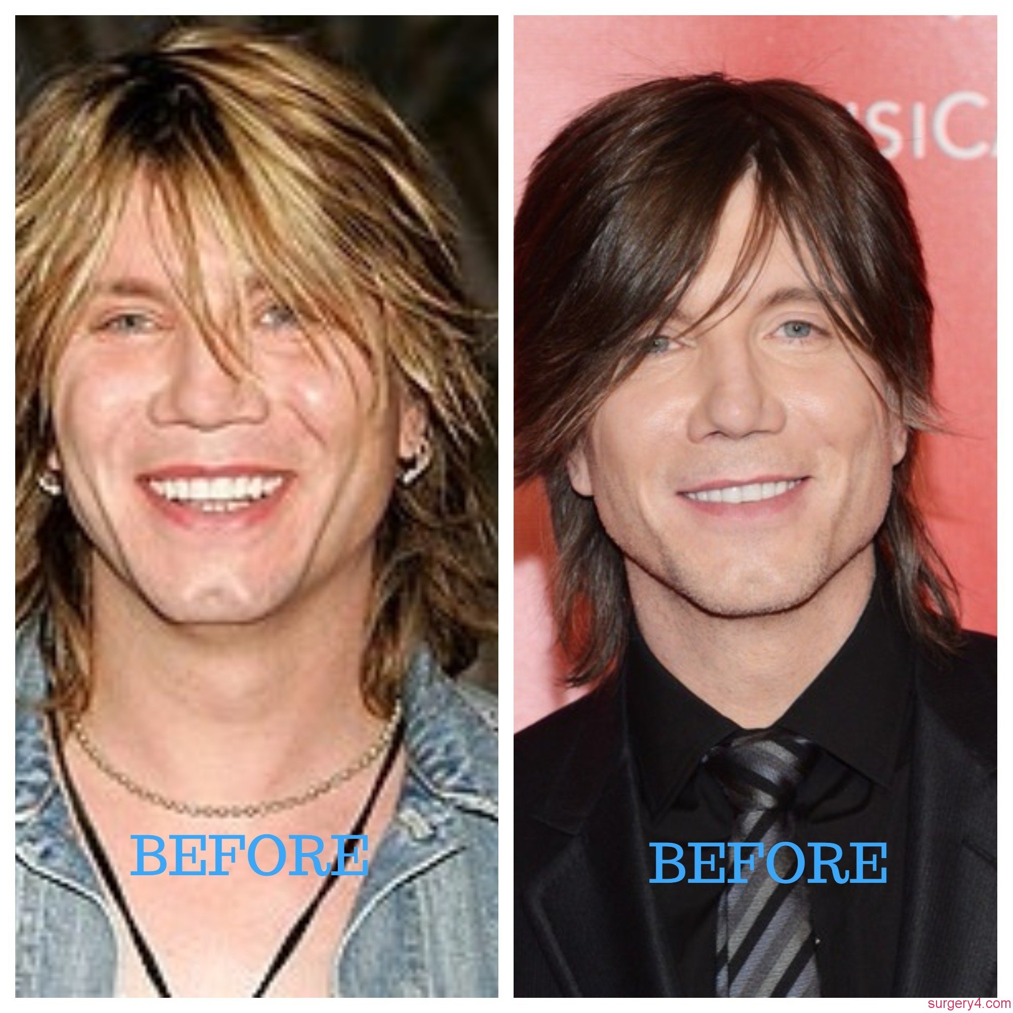 John Rzeznik Plastic Surgery Photos Before After Surgery4