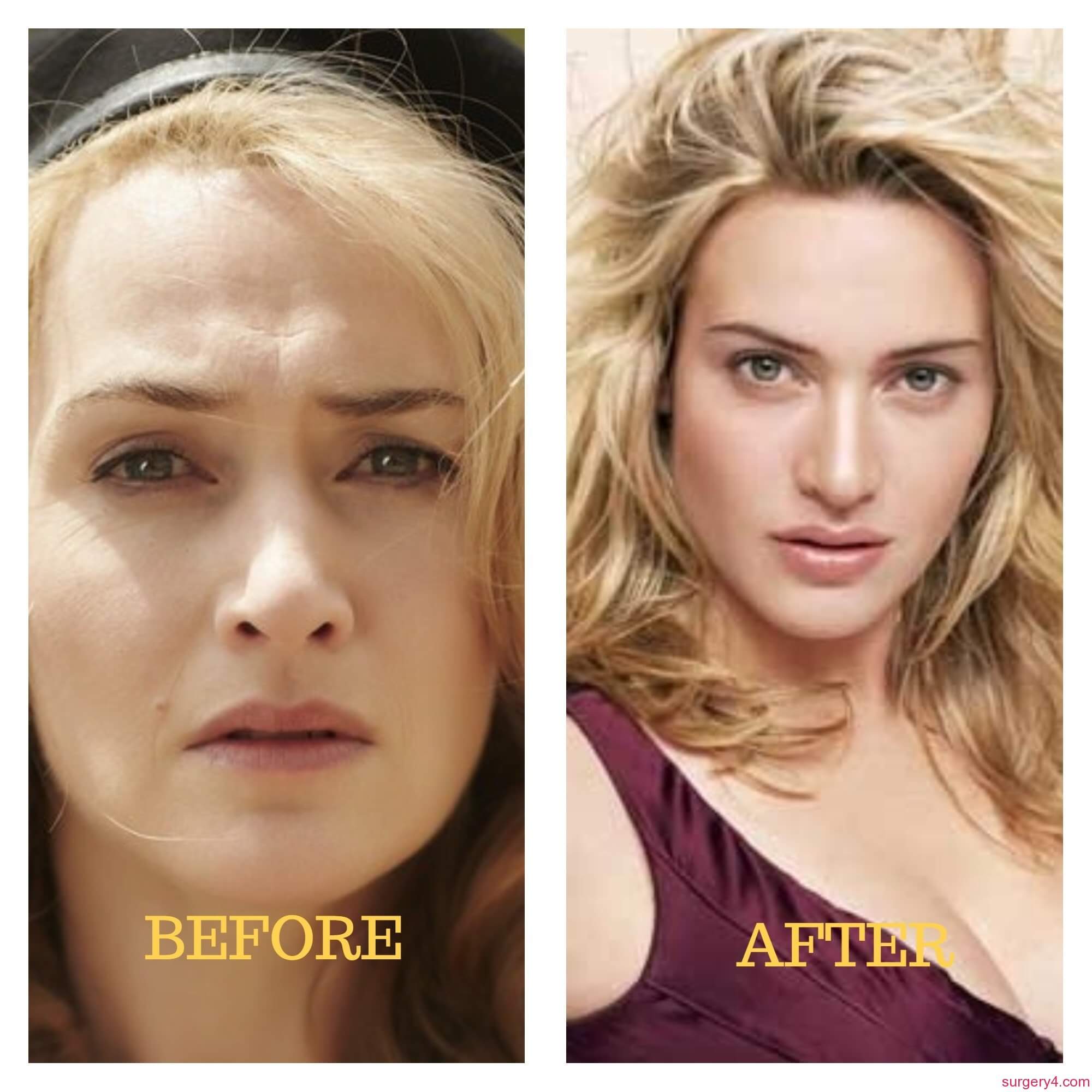 Kate Winslet Plastic Surgery - before & after