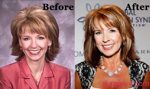 Kim Christiansen Plastic Surgery - Before and After