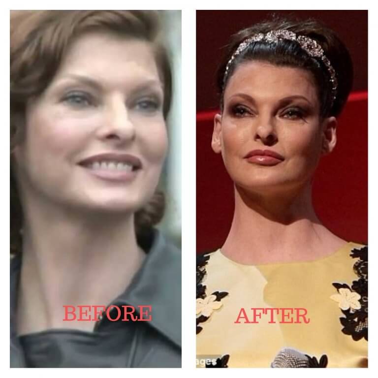 Joan Kennedy Plastic Surgery Photos [Before & After] Surgery4
