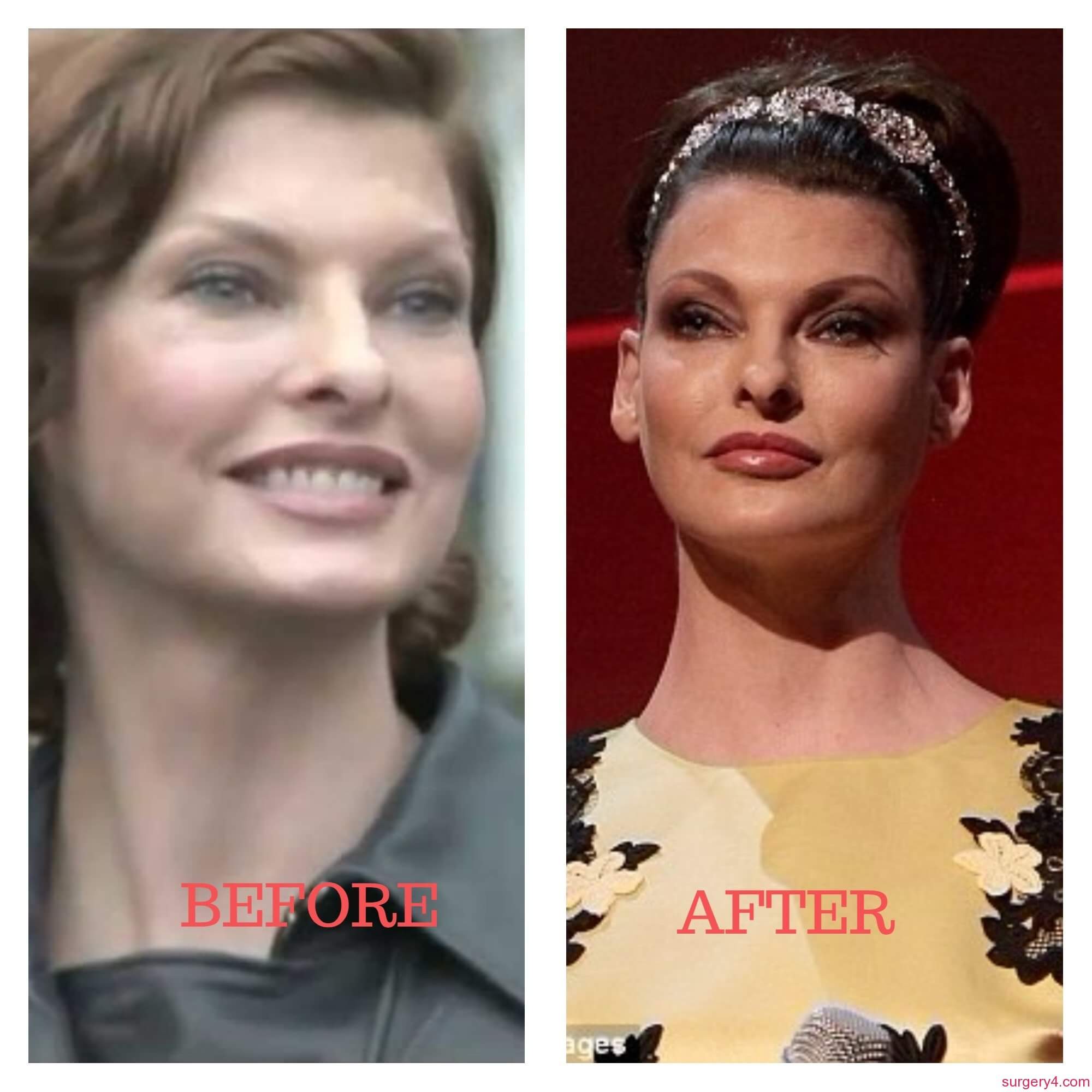Linda Evangelista Plastic Surgery - before and after