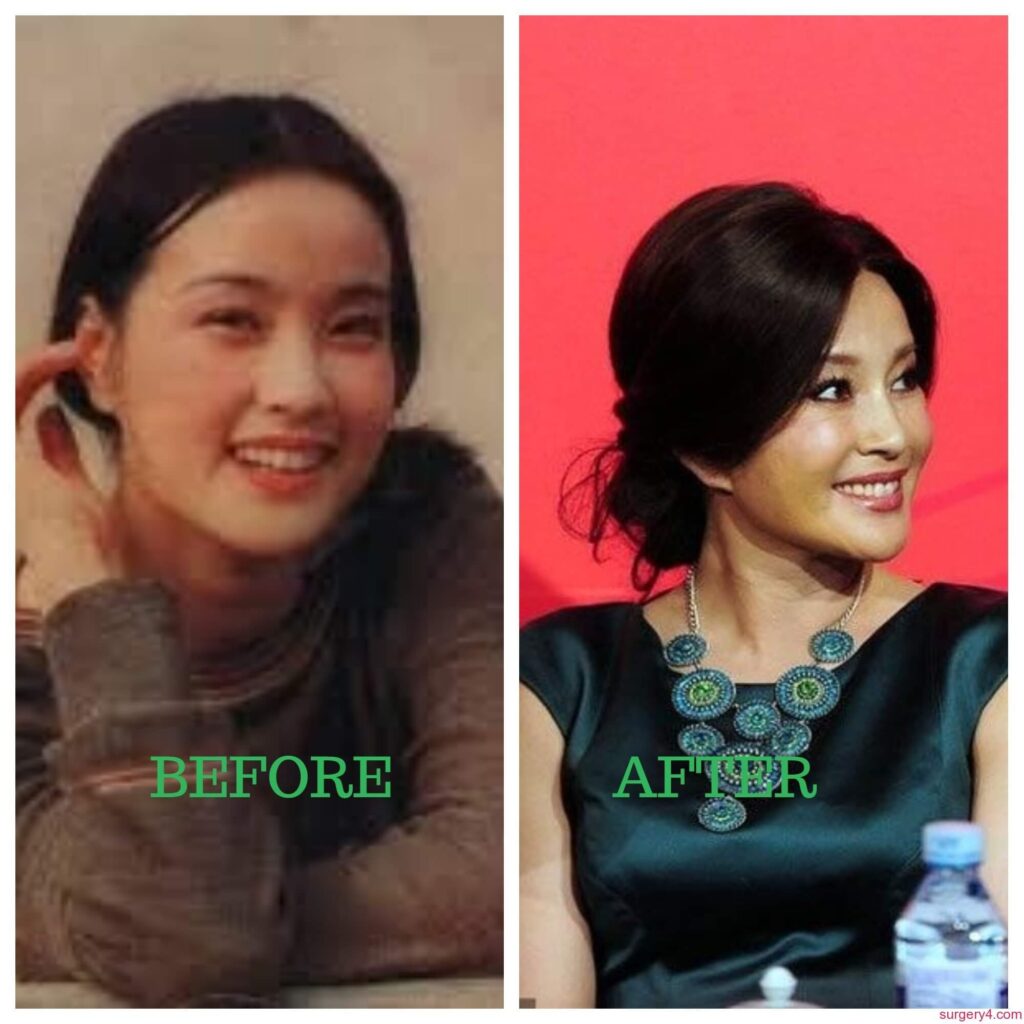 Liu Xiaoqing Plastic Surgery Photos [Before & After] ⋆