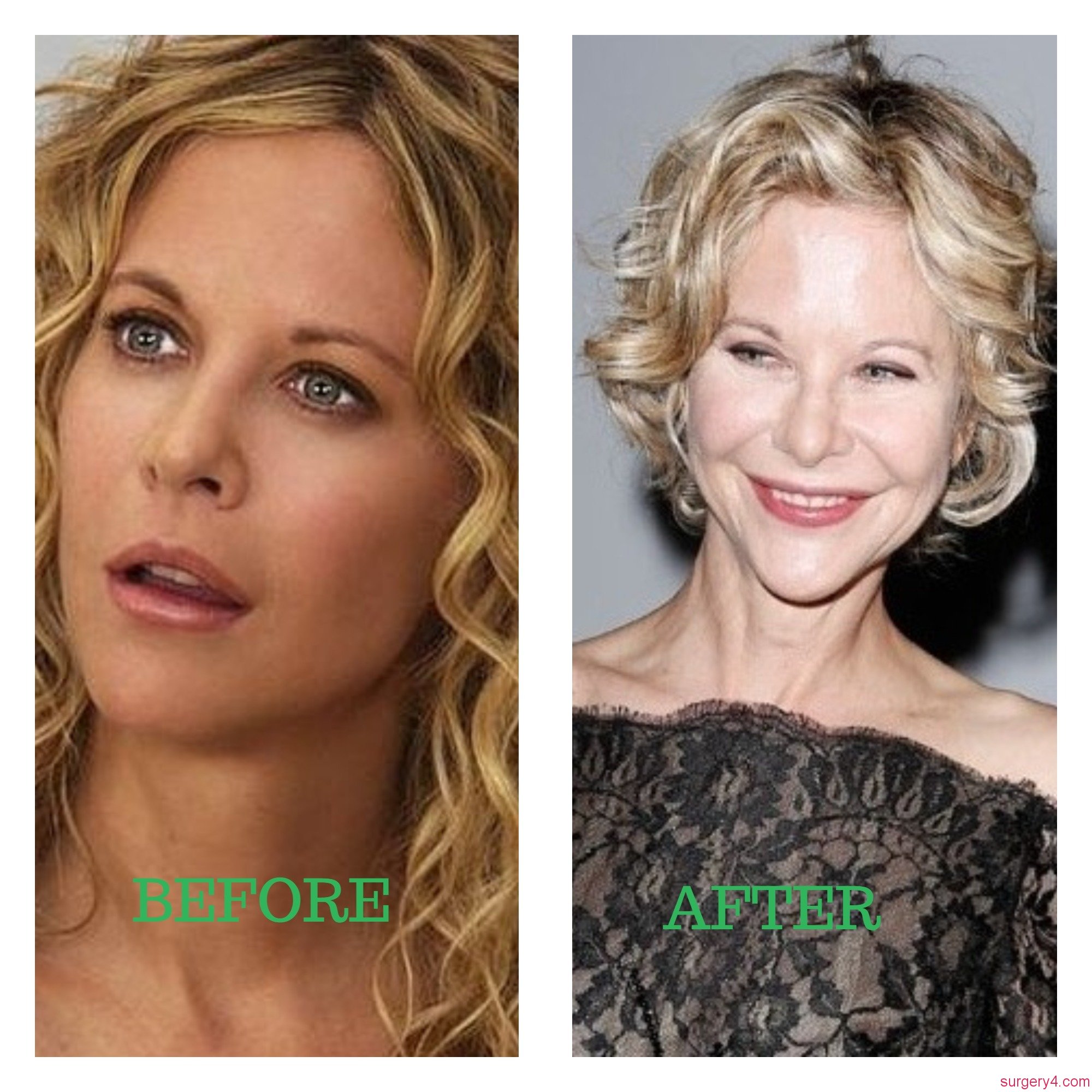 Meg Ryan Plastic Surgery Photos [Before & After] ⋆ Surgery4