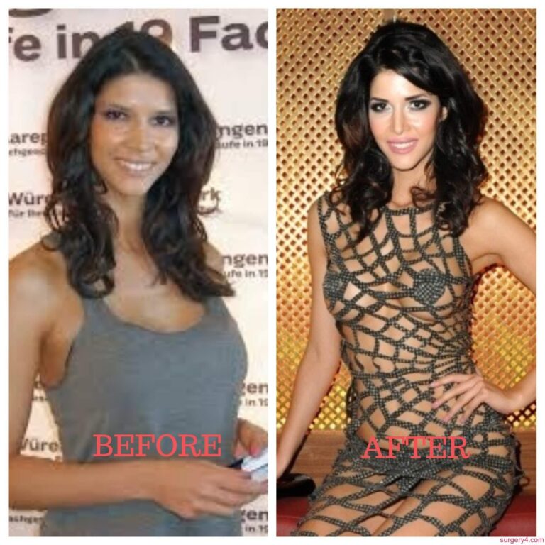 Joan Kennedy Plastic Surgery Photos [Before & After] Surgery4