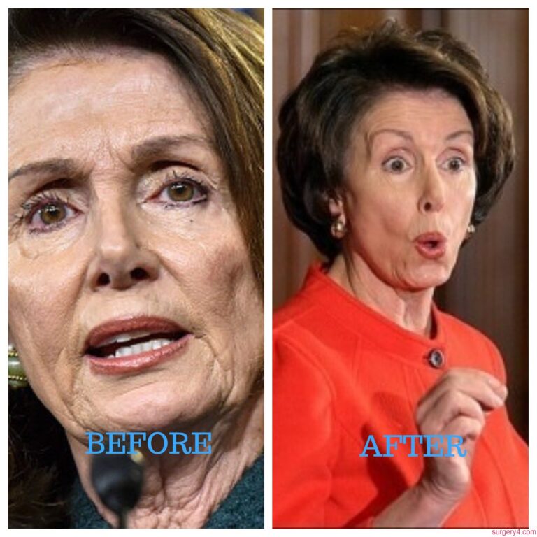 Joan Kennedy Plastic Surgery Photos [Before & After] Surgery4