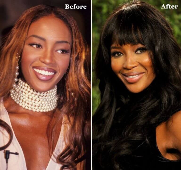 Naomi Campbell Plastic Surgery Nose Job Photos [Before & After] ⋆ Surgery4