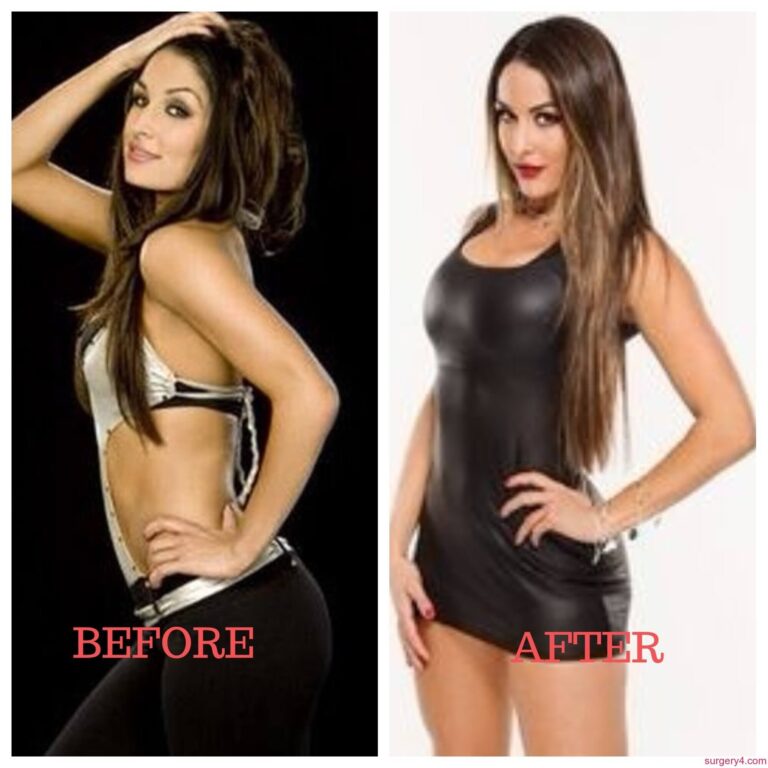 Joan Kennedy Plastic Surgery Photos [Before & After] Surgery4