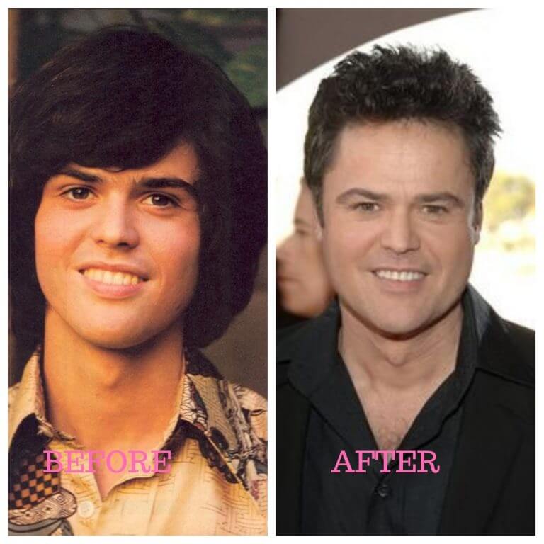 Donny Osmond Plastic Surgery Photos [Before & After] - Surgery4