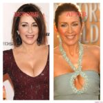 Patricia Heaton Plastic Surgery Photos Before After Surgery