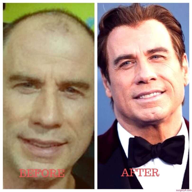 John Travolta Plastic Surgery - before and after