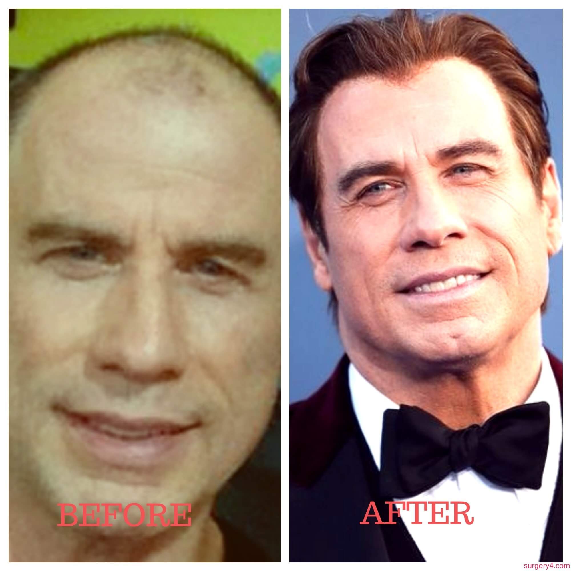 John Travolta Plastic Surgery Photos [Before & After] ⋆