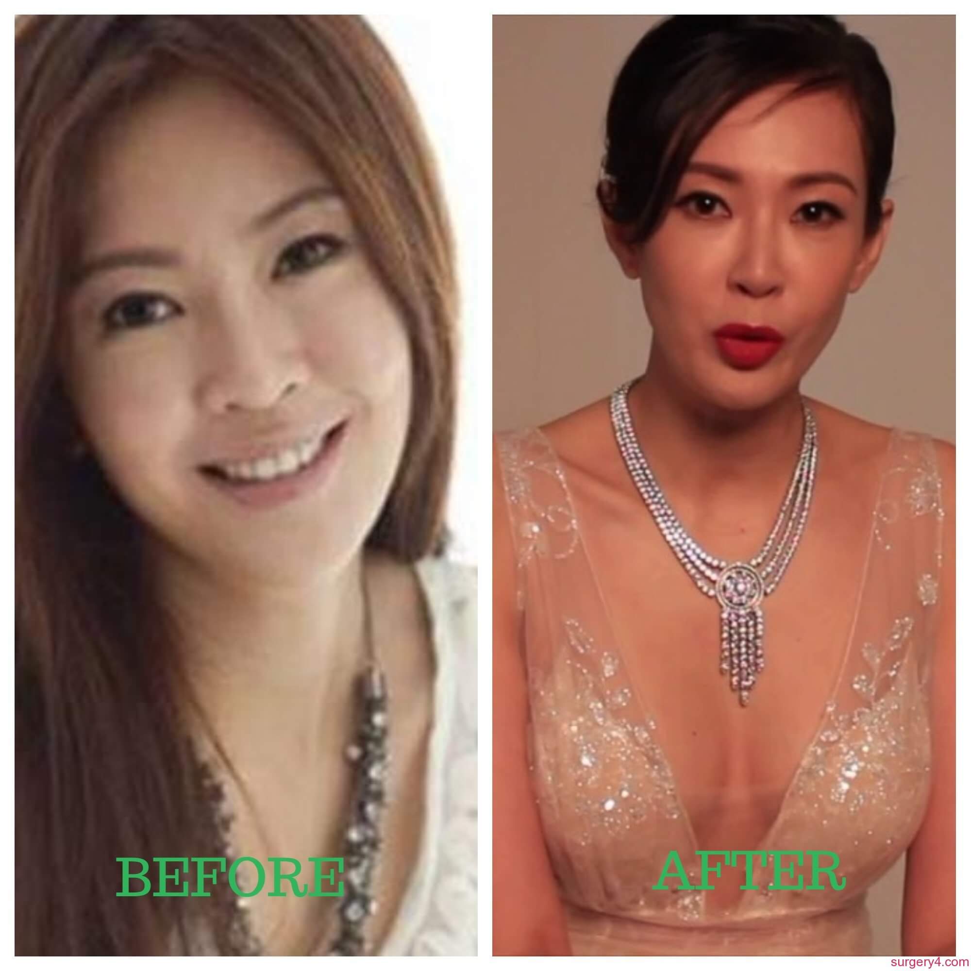 Jessica Liu Plastic Surgery Photos [Before & After] ⋆ Surgery4
