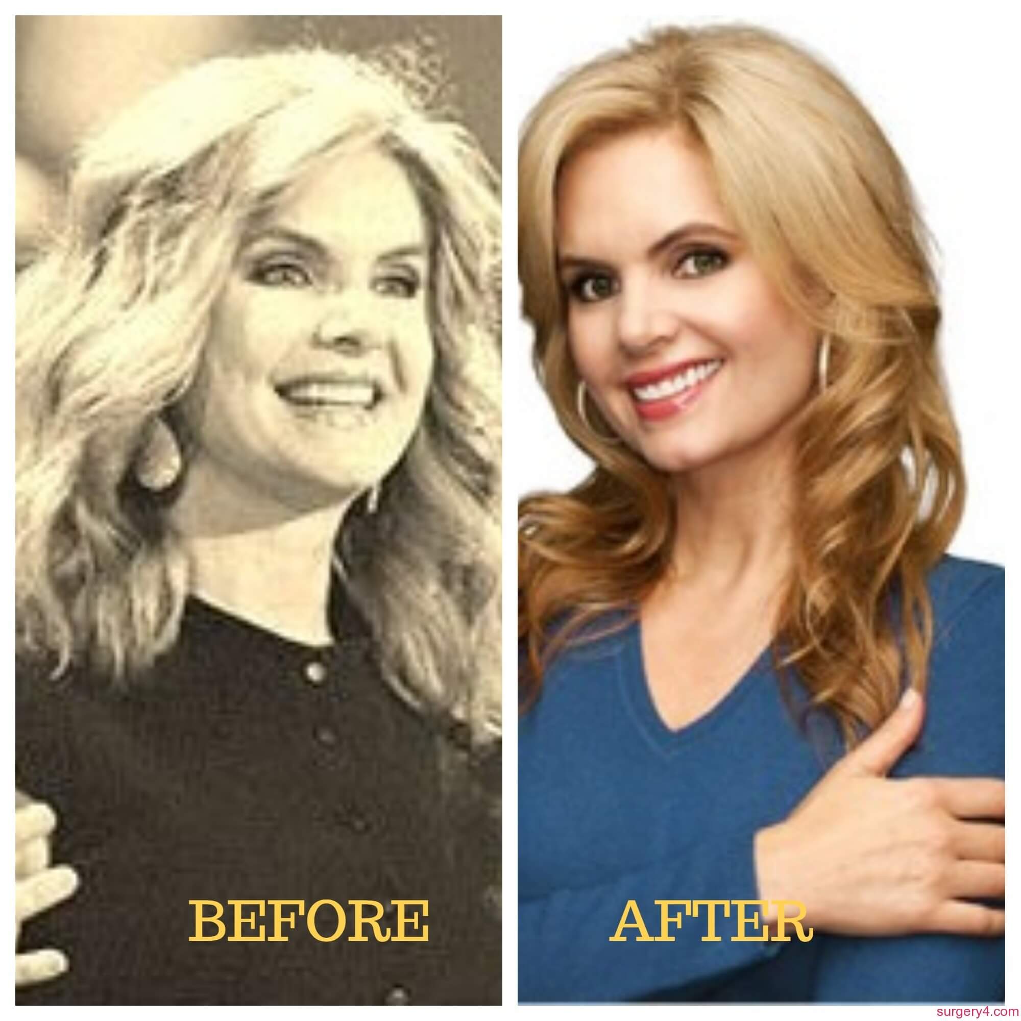 Victoria Osteen Plastic Surgery - Before and After