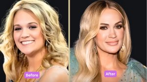 carrie underwood plastic surgery