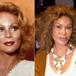 cat lady plastic surgery