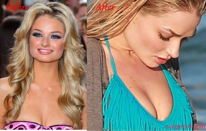 Emma Rigby Plastic Surgery - Before and After