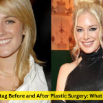 heidi montag before and after plastic surgery