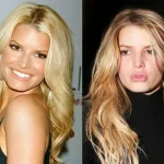 jessica simpson plastic surgery