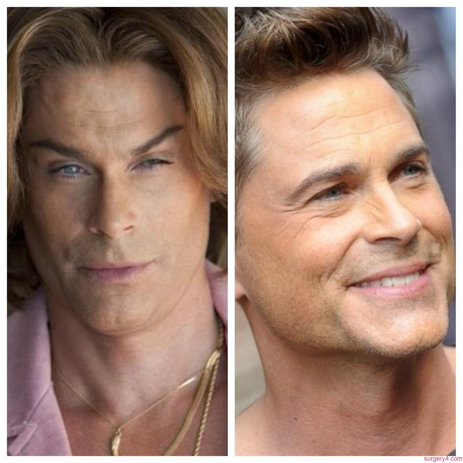 Rob Lowe Plastic Surgery Photos [Before & After] - Surgery4