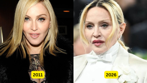 Madonna Plastic Surgery