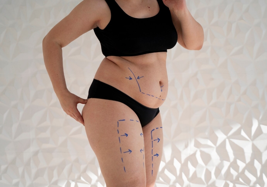 Which Areas of the Body Can Liposuction Treat