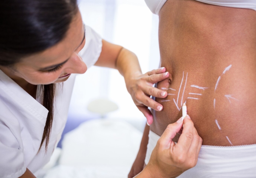 what is liposuction